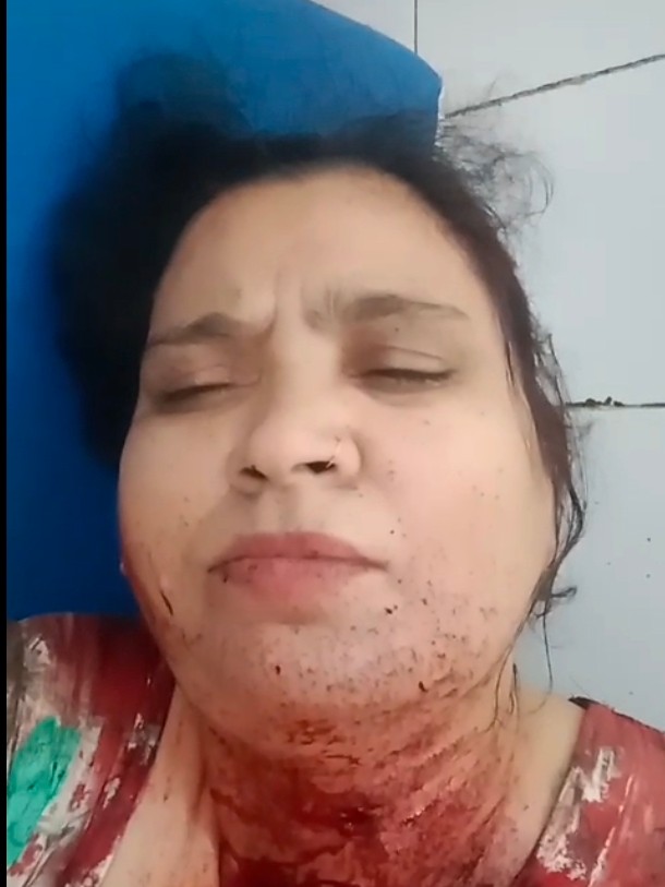 अलीगढ़ -भतीजे ने बुआ को मारी गोली, घायल JNMC में एडमिट